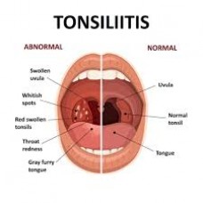 Tonsils